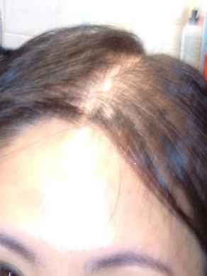 אחרי מילוי ועיבוי שיער